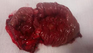 Pieza de resección de la anastomosis ileocólica donde se observa la ulceración circunferencial.