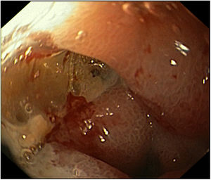 A deep ulcer with elevated borders and about 15mm of diameter on the anterior wall of the duodenal bulb.
