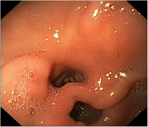 Two openings connecting the lesser curvature of the gastric antrum and the duodenal bulb, consistent with a double pylorus.