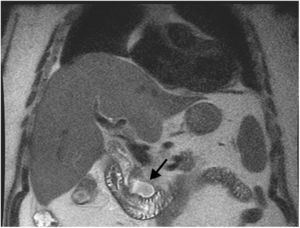 Abdominal T2-MRI scan. T2-contrast magnetic resonance imaging (MRI): a large juxtapapillary diverticulum (arrow) without intrahepatic or extrahepatic biliary dilatation.