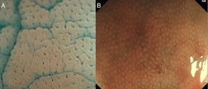 (A) Normal round pit pattern under magnified observation with indigo carmine. (B) Honeycomb-like appearance of the subepithelial capillary network in colon, under M-DWI.