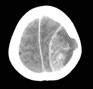 TC craneal: hematoma epidural agudo frontotemporal izquierdo. Lesión osteolótica en bóveda craneal de probable origen metastásico.