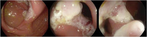 Ciego y válvula ileocecal con úlceras mucosas y estenosis fibrosa, que permite ver íleon distal normal.