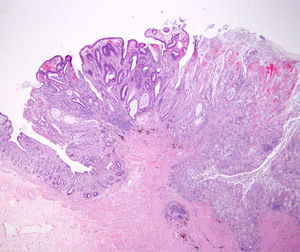 Imagen panorámica del pólipo (×4). En el lado izquierdo de la imagen se reconoce mucosa de colon, sin lesión histológica, la parte central muestra transformación adenomatosa y en la zona derecha se observa la presencia de células en anillo de sello ocupando las luces glandulares.