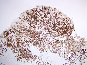 Ausencia de patrón infiltrativo (×4). Mediante la tinción con panqueratina se demuestra la ausencia de patrón infiltrativo. Todas las células epiteliales (las células tipo anillo de sello y el epitelio glandular mucosecretor) son positivas y se encuentran delimitadas por membrana basal.