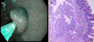A) Imagen con narrow-band imaging del adenoma. Patrón de superficie homogéneo con patrón vascular conservado. B) Proliferación de glándulas de Brunner y ductos sin atipias, rodeadas de islotes de estroma adiposo maduro en submucosa duodenal (4X HE).