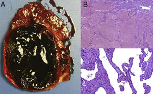 Pieza quirúrgica de hepatectomía derecha: A) Imagen macroscópica. Tumor bien delimitado de 14cm de dimensión máxima, de aspecto hemorrágico friable. B) Imagen microscópica que muestra canales vasculares de contenido hemático, con extensos cambios de necrosis coagulativa (H&E, ×4). C) Imagen microscópica a mayor aumento que muestra espacios vasculares revestidos por endotelio plano sin atipia (H&E, ×20).