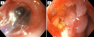(A) Pneumatic dilatation. (B) 15mm colonic perforation with epiploic fat visualization.