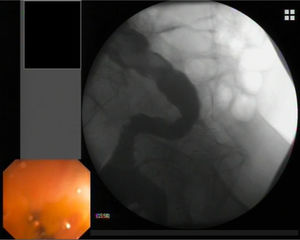 Absence of leakage and inicial stenosis resolution demonstrated with contrast injection.