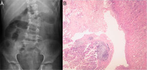 A) Anormalidades vertebrales: escoliosis causada por hemivértebra y anquilosis de L4-L5. B) Histopatología de colon: epitelio ulcerado, inflamación crónica con agregados linfoides e hiperplasia muscular con áreas de fibrosis y necrosis.