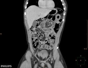 TAC abdominal: imagen correspondiente a invaginación intestinal a nivel de yeyuno proximal.