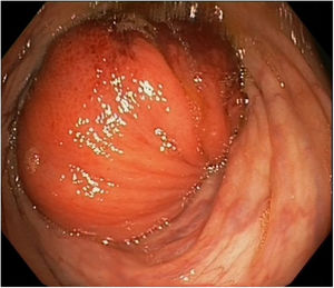 Imagen endoscópica que muestra la invaginación intestinal.