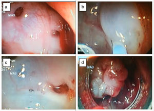 (a) Bleeding diverticula in the sigmoid colon; (b) Adrenaline injection around the bleeding diverticula, conditioning mucosal elevation in the diverticular area; (c) endoscopic tattooing was performed to allow the identification of the bleeding diverticula; (d) EBL of the bleeding diverticula.
