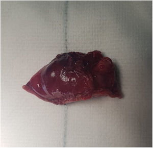 Muñón apendicular resecado por vía laparoscópica.