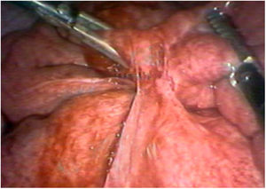 Visión quirúrgica durante laparotomía. Se observa la formación temprana de una adherencia entre el omento y el intestino delgado.