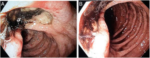 A y B) Úlcera profunda de aspecto infiltrativo a nivel de duodeno distal.