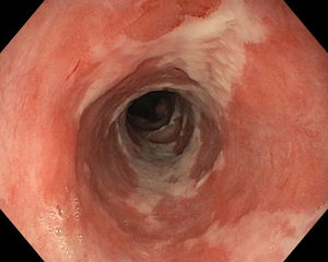 Imagen endoscópica de esófago medio en la que se observa mucosa esofágica en proceso de reepitelización con zonas parcheadas de fibrina y mucosa normal.