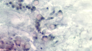 Células mucosecretoras englobadas en material mucinoso. Se observan grandes vacuolas de mucina citoplasmáticas que desplazan el núcleo a la periferia (Papanicolaou ×20).