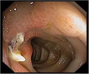 Colonoscopy showed an inflamed diverticulum with purulent drainage.