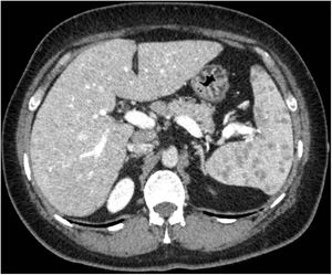 Axial MultiDetector Computed Tomography that shows the presence of hepatic and splenic multiple micro-nodular formations.