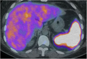 Axial PET/CT scan that confirms the increased SUV at liver and splenic level.