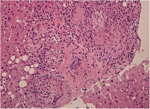 Histopathological evaluation that shows granuloma formations, T-lymphocytes, multinucleated giant cells and fibrosis.
