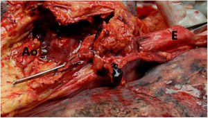 Fístula aortoesofágica en autopsia. Ao: aorta; E: esófago.