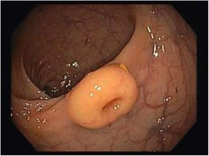 Colonoscopy: In the midrectum, a 12mm, sessile, subepithelial lesion covered with yellow discolored mucosa, with a central depression.