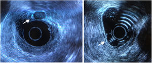 Rectum endoscopic ultrasound: hypoechoic lesion with 12mm (arrow), homogeneous, well delimited, originating in the muscularis of the mucosa with no lymph nodes or muscularis propria involvement.