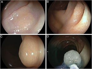 Example 1: (A) A mucus-covered flat lesion as identified with image-enhanced endoscopy using linked color imaging (LCI, Fujinon). (B) After acetic acid spraying, multiple punctate black spots corresponding to open pits became visible. Example 2: (C) A polypoid right-colonic lesion with an exuberant mucus cap. (D) After washing and submucosal indigocarmin injection slow closure of a standard snare resulted in a presumed accentuation of surface open pit pattern highly suggestive of sessile serrated adenoma/polyp (SSA/P).