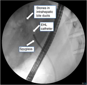 Cholangiogram with SpyGlass™ in intrahepatic bile duct proximal and intrahepatic stones during ERCP.