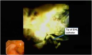 Cholangioscopy view of EHL catheter facing a compact intrahepatic bile conglomerate.