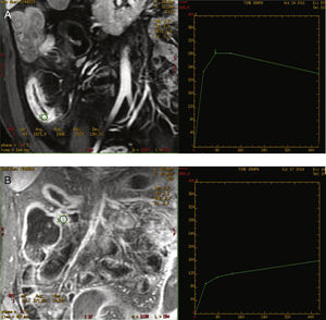 Magnetic resonance enterography and pattern curves. Image A represents inflamed bowel area and its corresponding inflammatory enhancement curve. Image B represents a fibrotic stenosis and its corresponding enhancement curve.