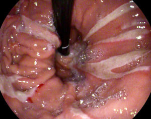 Imagen endoscópica en retroflexión de erosiones lineales múltiples en saco herniario compatibles con úlceras de Cameron.