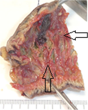 Imagen macroscópica de la pieza quirúrgica que muestra pliegues congestionados con áreas rojizas y área ulcerada (flecha).