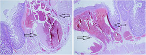 Imagen microscópica de la pieza quirúrgica que muestra arquitectura intestinal conservada con presencia de área submucosa expandida con una proliferación benigna de estructuras vasculares con luces dilatadas compatible con hemangioma cavernoso (flechas).