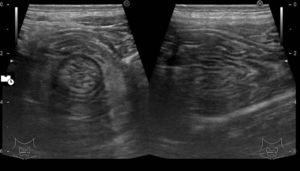 A jejune intussusception at ultrasound in a diabetic male with chronic diarrhea.