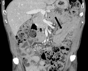 Abdominal computer tomography confirms the jejune intussusception (arrow).