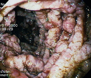 Upper endoscopy, duodenum, second portion. Oedema and white plaques in the mucosa.