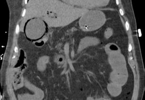 Coronal Abdominal Computed Tomography presented gas in the wall and lumen of the gallbladder and air in the intrahepatic biliary tract.