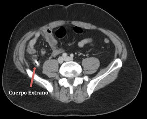 Tomografía computarizada de abdomen: se visualiza cuerpo extraño metálico dentro de apéndice cecal con cambios inflamatorios asociados compatibles con apendicitis aguda.
