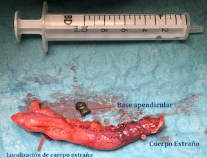 Pieza operatoria: se observa apéndice cecal con incisión en su 1/3 distal de donde se extrajo cuerpo extraño metálico (perdigón de cacería).