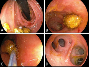 (A) Retroflexed view in the descending duodenum with multiple stones during freehand intubation of the papilla for direct cholangioscopy access using an ultra-slim upper endoscope (“hooking” technique). (B) An estimated 10-mm residual biliary stone in the middle of a diffusely dilated common bile duct, (C) extracted with a small-sheath (5-Fr; working channel 2.0mm) Dormia basket. (D) Confirmation of freedom from stones with high-quality assessment of the biliary system up to the hilum and (not shown), in part, intrahepatic ducts.