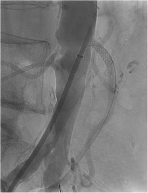 Imagen angiorradiológica durante el implante de stent en AMI.
