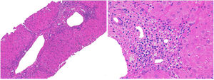 Liver biopsy, which shows septal fibrosis and periportal hepatitis with lymphoplasmocytic and eosinophilic infiltration.
