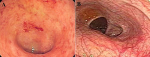Colonoscopy finding of 43-year-old woman with presentation of dysentery which was resulted in patchy erythema.