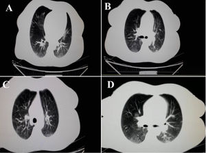 Chest CT scans (transverse plane) of 43-year-old woman with presentation of dysentery due to the infection with SARS-CoV-2. Chest CT resulted bilateral peripheral ground glass, crazy paving and small consolation opacities.