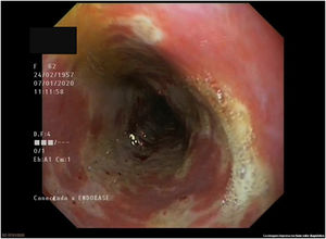 Imagen del tercio distal esofágico con presencia de esofagitis severa abarcando toda la circunferencia, así como una mucosa friable, exudados blanquecinos y ulceraciones.