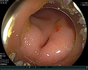 Rectal perforation discovered by colonoscopy.