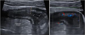 A: Estenosis de la luz (las flechas discontinuas indican el estrechamiento progresivo de la luz. Se acompaña de proliferación fibrograsa muy evidente y alguna úlcera (asterisco). B: Señal Doppler marcada (Limberg 2-3) que indica la presencia de hiperemia y por tanto es una estenosis con actividad inflamatoria.